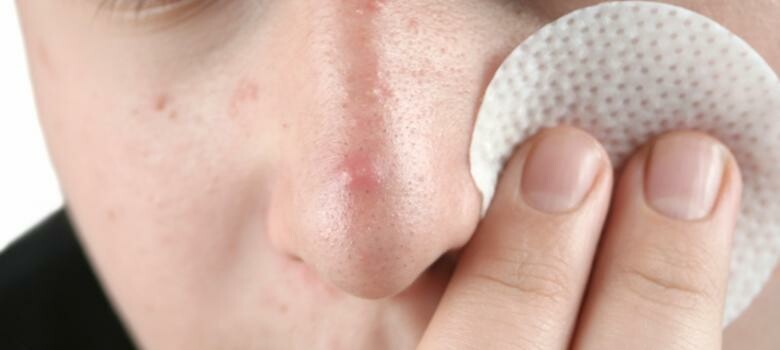 Easing Acne Angst