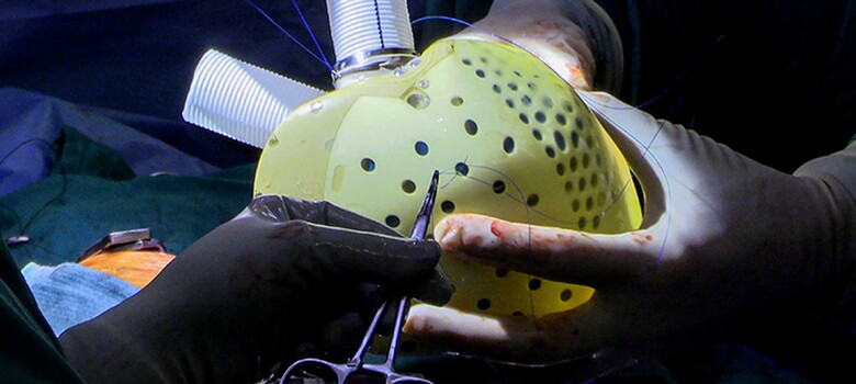 Duke Surgeons First in U.S. to Place New-Generation Artificial Heart