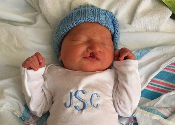 Jack as a baby with a cleft lip and palate