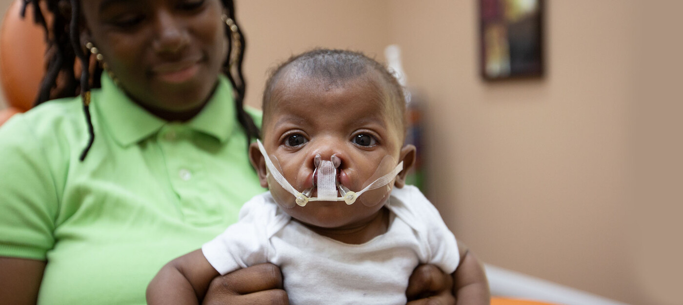 A mother holds her baby who is wearing a NAM device. The NAM device slowly brings gum and lip segments together to reduce the number of surgeries required to fix a cleft. Results are more symmetrical when using a NAM device.
