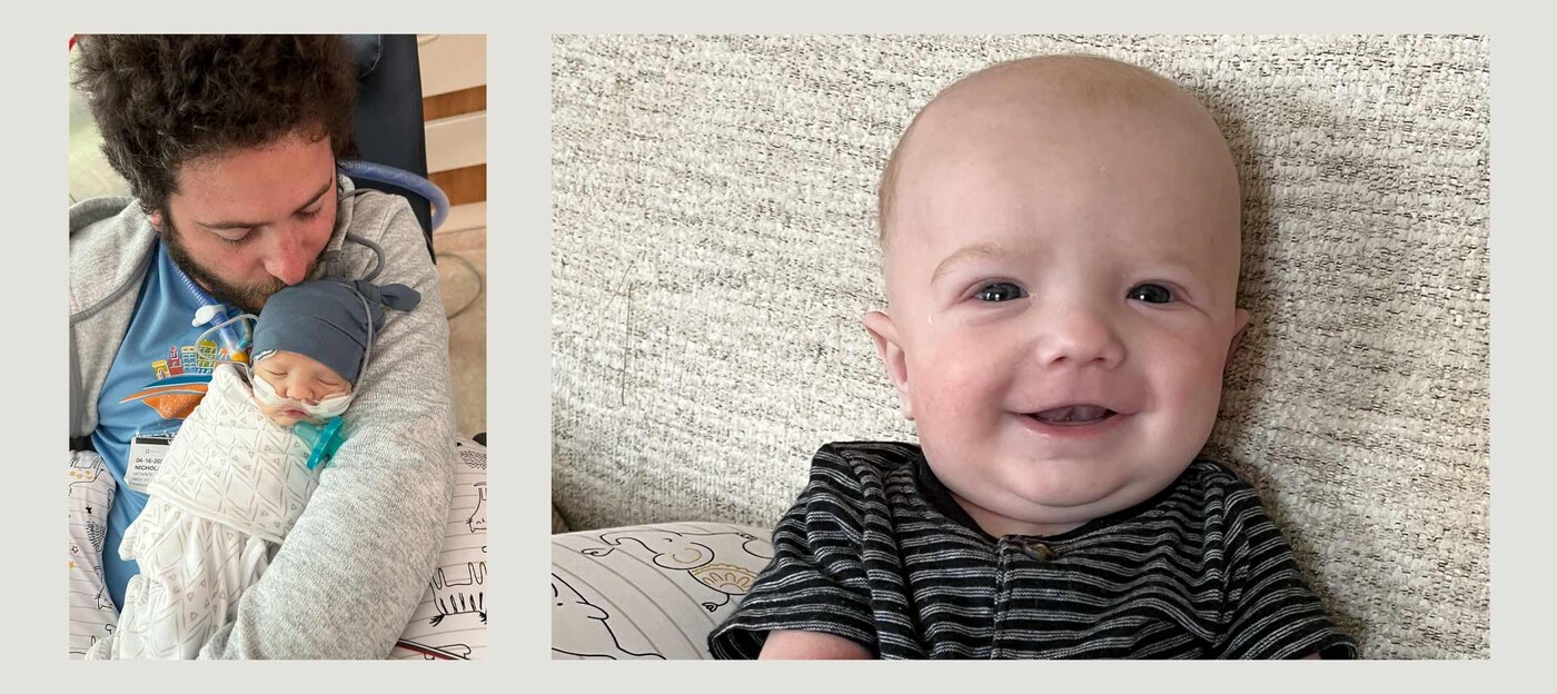 A newborn Owen with his dad before surgery (left). Owen smiling after surgery (right). Newborn Owen with his dad before surgery and a second photo of Owen smiling after surgery.